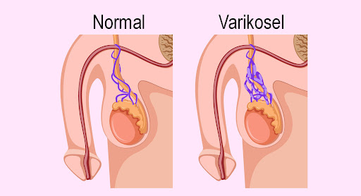 varikosel-nedir